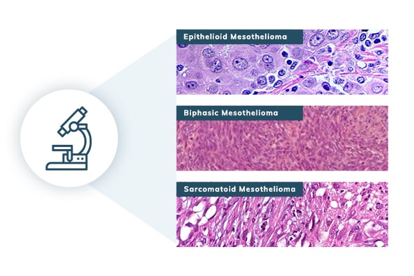 Mesothelioma pathology showing cell types under a microscope